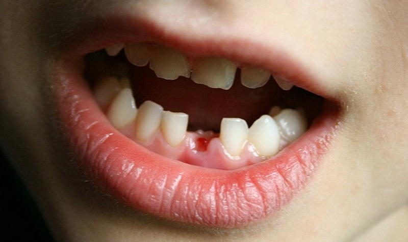 Trẻ em bị mất răng sớm không nên trồng răng Implant