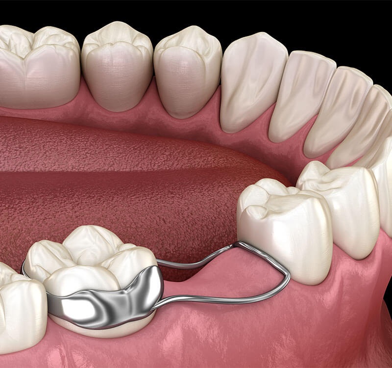 Việc trồng răng Implant quá sớm có thể gây sai lệch khớp cắn