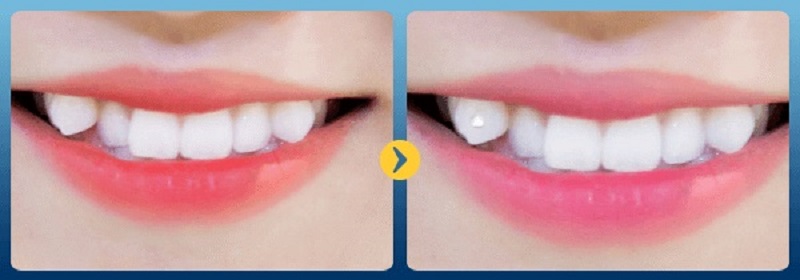 Răng khểnh có thể trồng được bằng nhiều kỹ thuật khác nhau