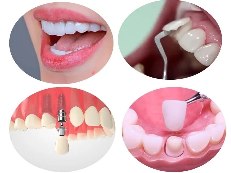 Hiện nay có thể trồng răng khểnh bằng phương pháp dán sứ, trồng răng Implant, cầu răng sứ