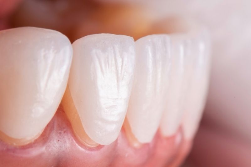 Veneer Ceramill