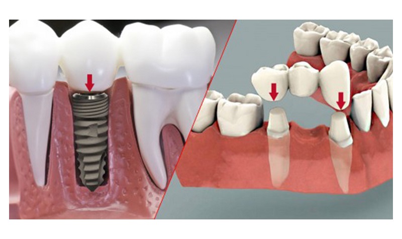 Trồng răng Implant là giải pháp khắc phục mất răng hiệu quả