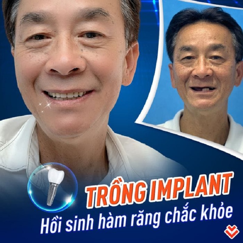 Bệnh viện Thẩm mỹ Kangnam trồng răng Implant chất lượng cao
