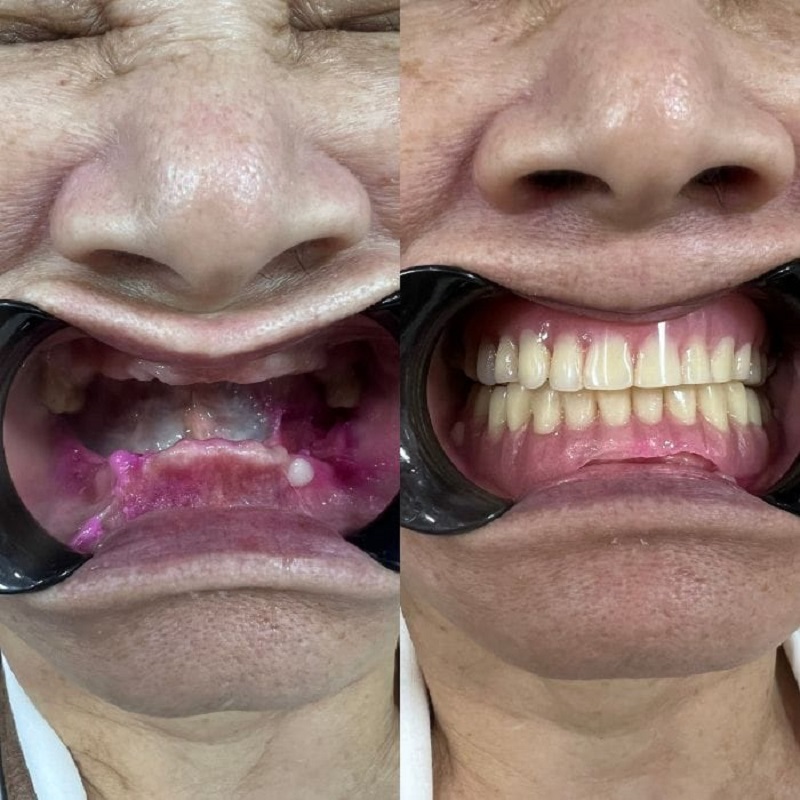 Sử dụng trụ cao cấp, đảm bảo chức năng ăn nhai cho khách hàng