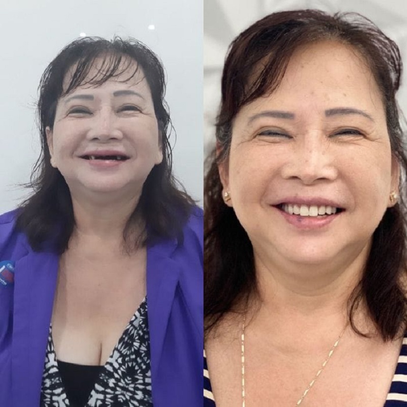 Duy trì độ bền lâu dài sau khi trồng răng