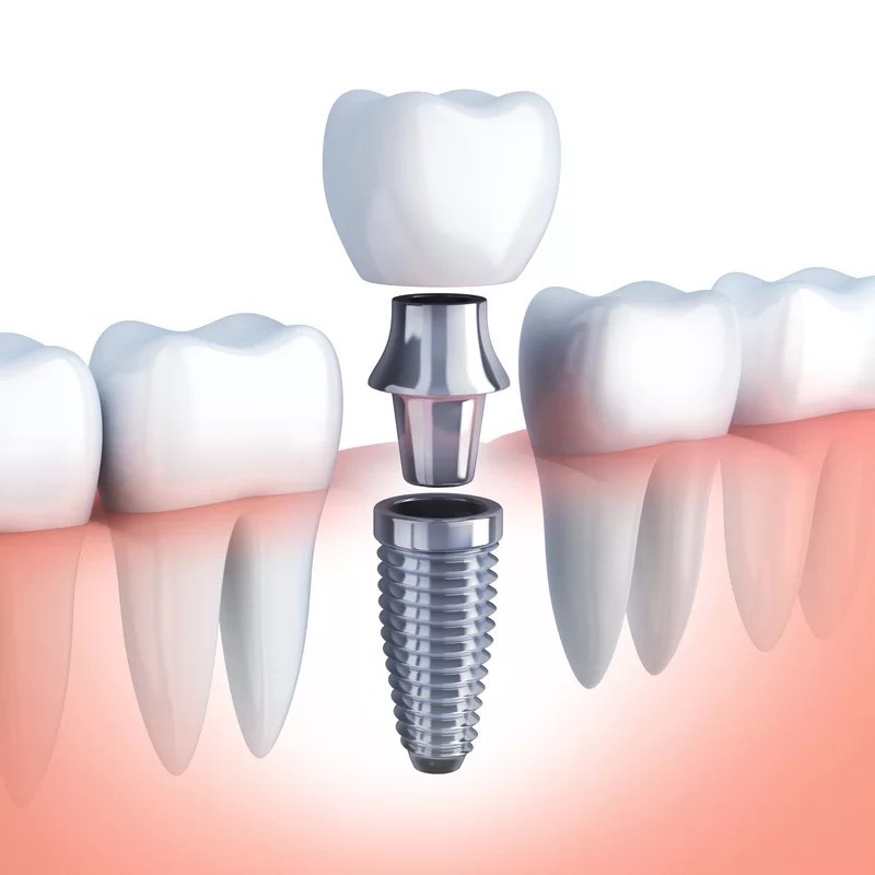 Lựa chọn địa chỉ sử dụng trụ Implant chất lượng cao