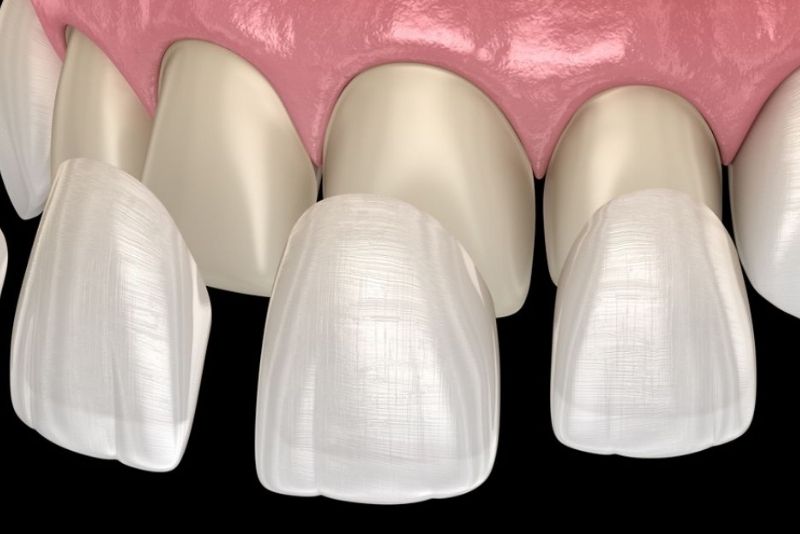 Số lượng răng cần dán quyết định tổng chi phí