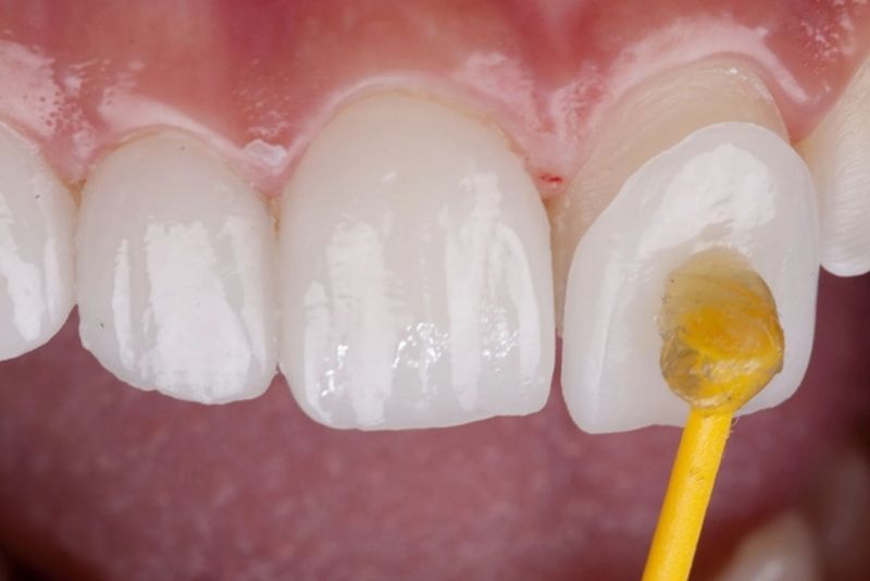 Răng đều, thẳng, không sứt mẻ thì dán sứ không cần mài