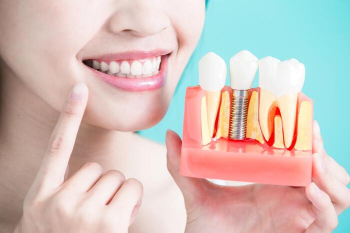 Có thể trồng răng Implant khi đủ tuổi