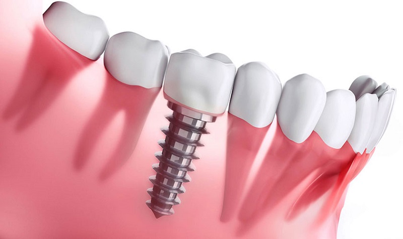 Trồng răng Implant giúp khắc phục tình trạng mất răng hiệu quả