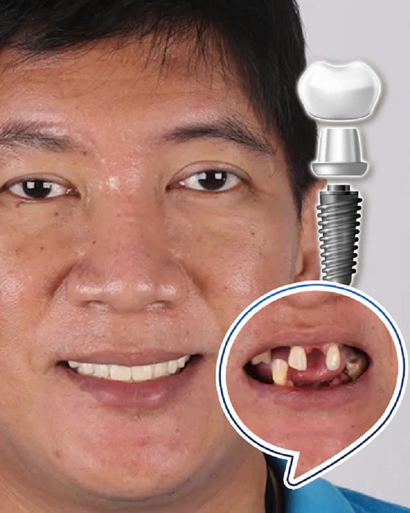 Duy trì tính thẩm mỹ và bảo tồn được răng thật xung quanh