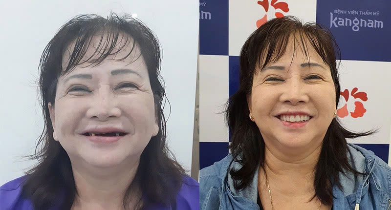 Sau khi trồng răng sẽ cải thiện chức năng ăn nhai như răng thật