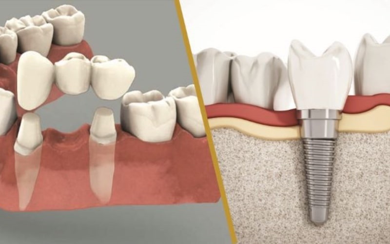 Thay thế chân răng bằng trụ Implant hoặc cầu răng sứ