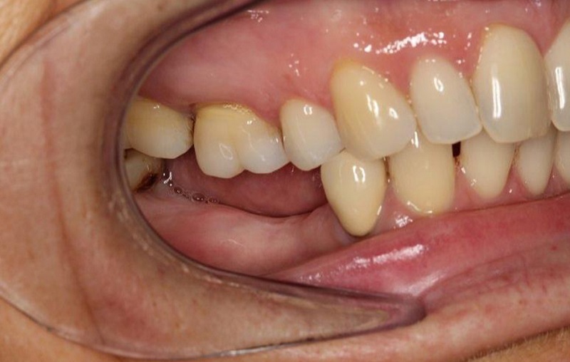 Khách hàng mất răng lâu năm có thể trồng lại răng 