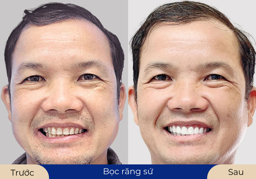 Tăng tính thẩm mỹ cho gương mặt