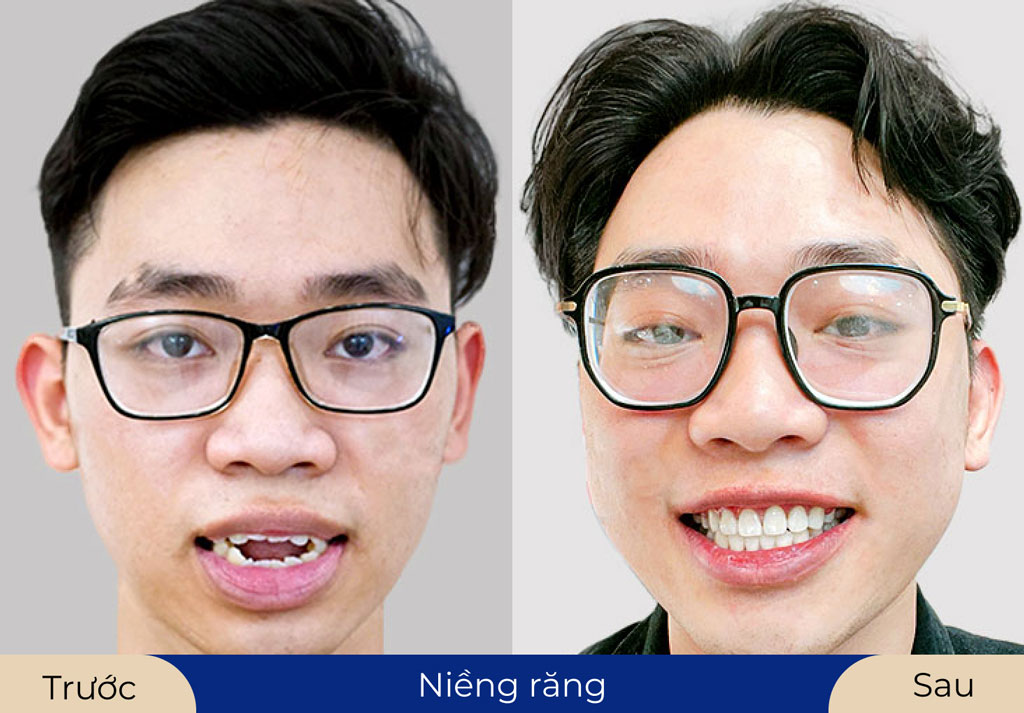 Niềng răng cải thiện hô do răng