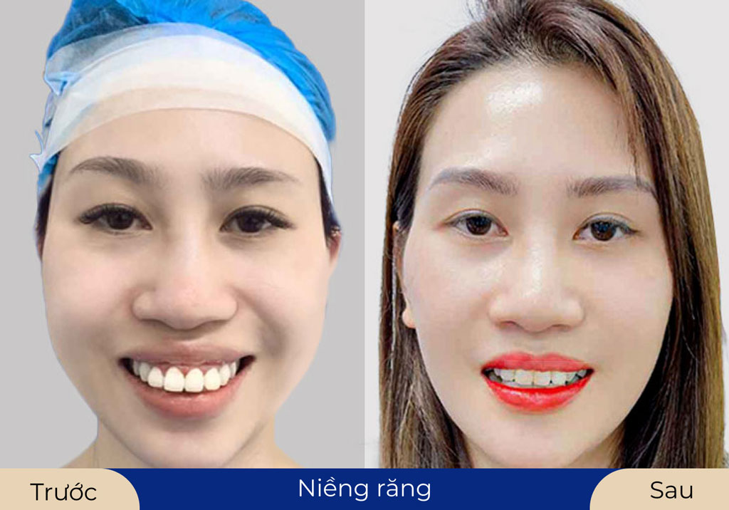 Màu sắc răng tự nhiên như thật