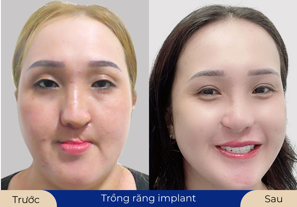 Chi phí trồng răng sứ khá cao