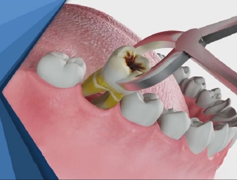 Cần trồng răng cấm ngay sau khi nhổ răng