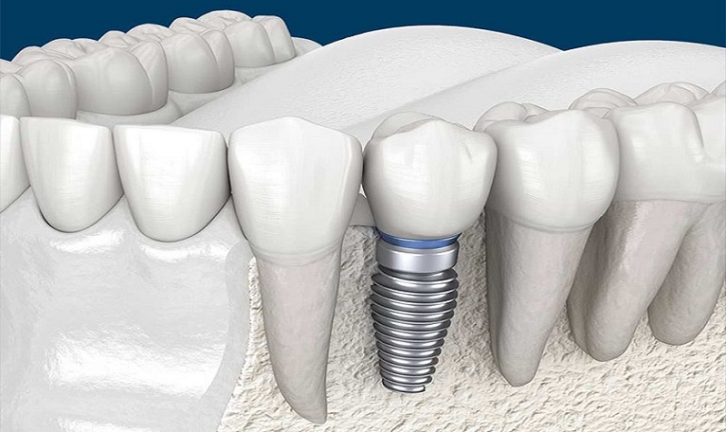Trồng răng Implant giúp cải thiện chức năng ăn nhai, ngăn ngừa tiêu xương