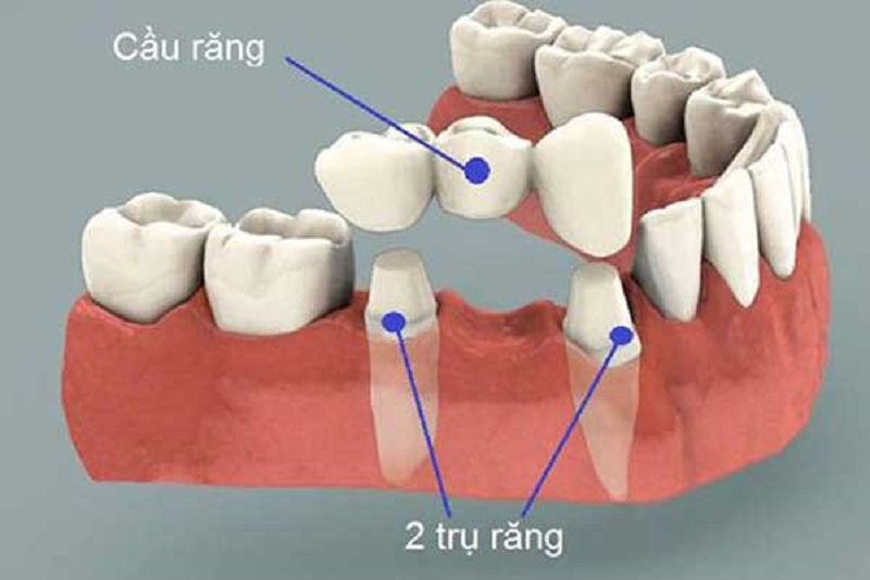 Cầu răng sứ là phương pháp có thể thực hiện