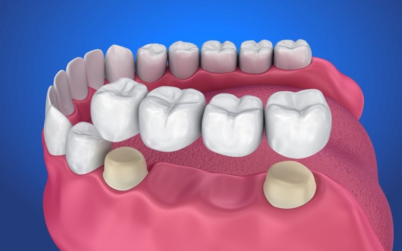 Cầu răng sứ được dùng để thay thấy răng hàm