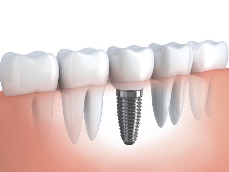 Trồng răng Implant giúp thay thế răng hàm đã nhổ