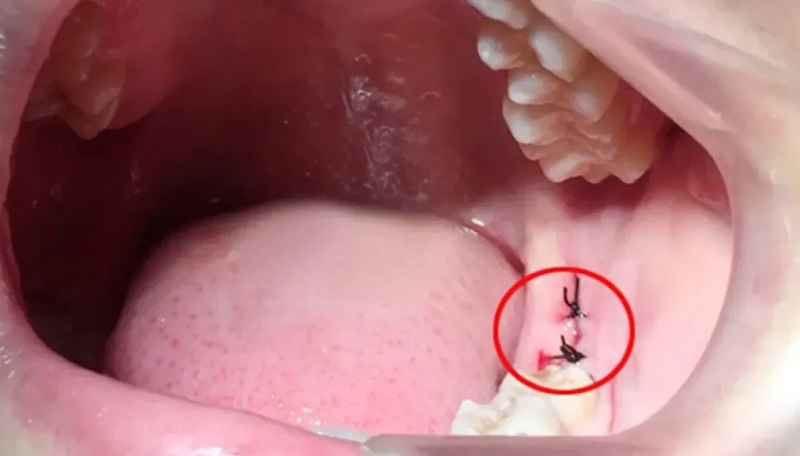 Sau khi nhổ răng khách hàng nên để vết thương phục hồi rồi tiến hành trồng răng