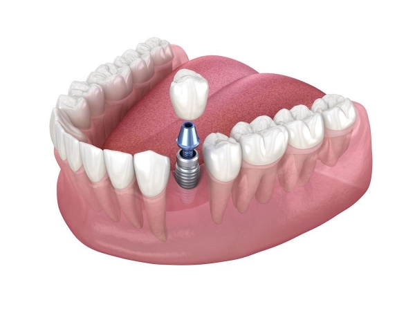 Trồng răng Implant giúp đảm bảo an toàn và hiệu quả cao