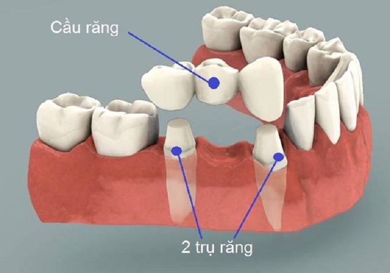 Cầu răng sứ có thể lắp khi ổ răng số 6 sau nhổ đã lành