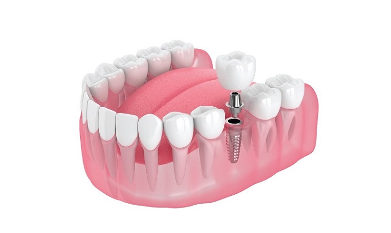 Trồng răng Implant là giải pháp an toàn và duy trì lâu dài