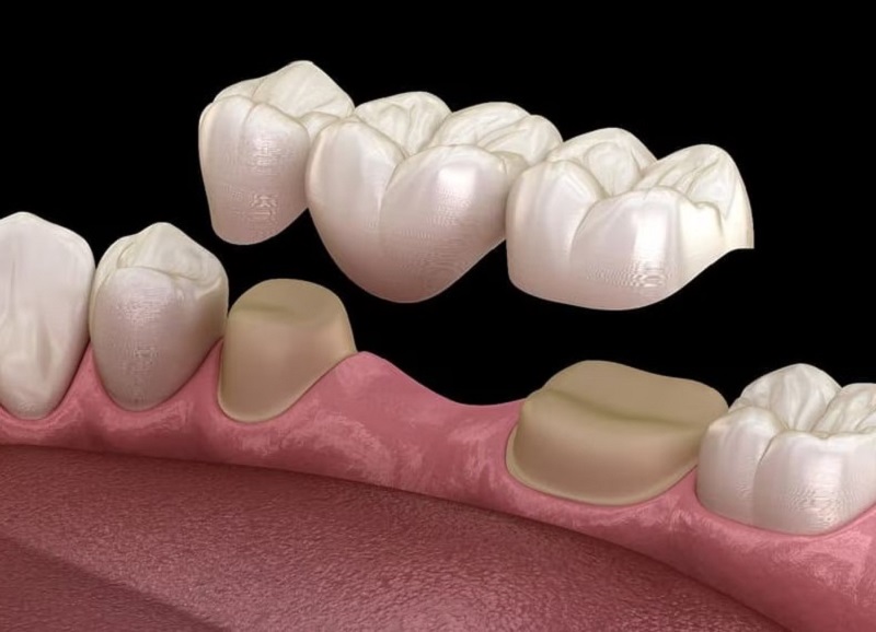 Cầu răng sứ có thể thực hiện sau vài ngày nhổ răng số 7