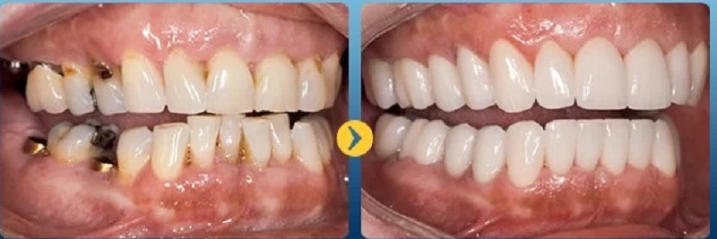 Trồng răng số 7 lại sau 1 - 2 tháng khi vết thương đã ổn định