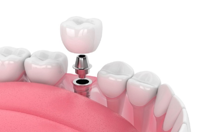 Implant cũng có những nhược điểm khi trồng