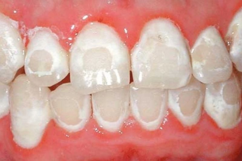 Độ bền không cao, màu sắc răng loang lổ