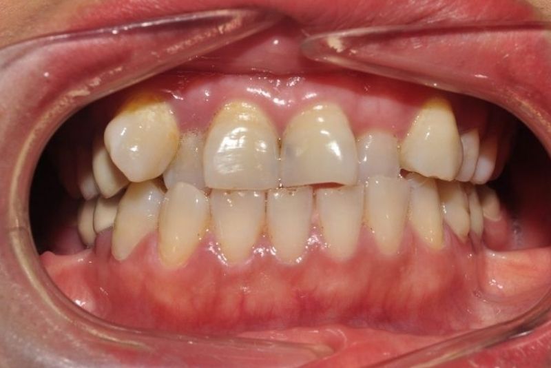 Răng khấp khểnh không nên phủ sứ nano