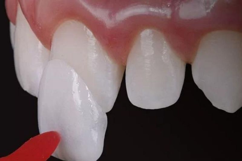 Dán sứ Veneer có độ bền cao