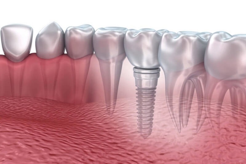 Thời gian tích hợp trụ Implant sẽ kéo dài lâu hơn