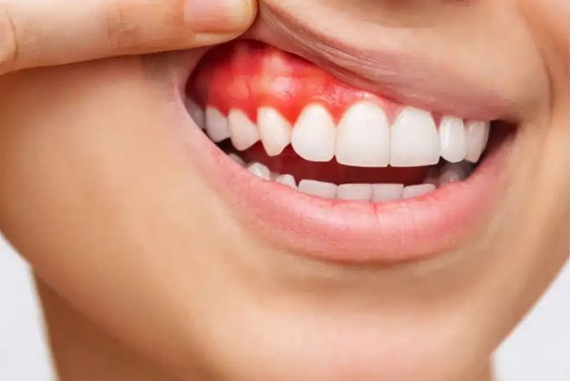 Viêm nướu có thể khiến răng sứ bị đau