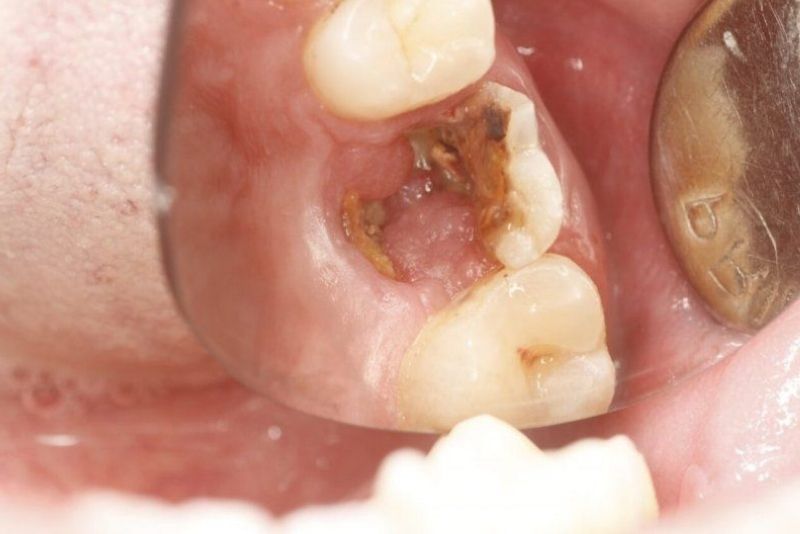 Răng bọc sứ bị viêm tủy