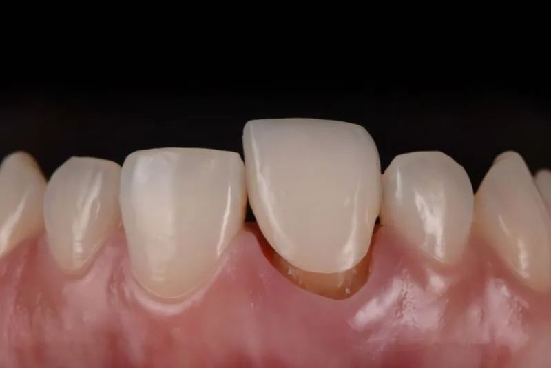 Mão sứ lỏng không thể niềng răng