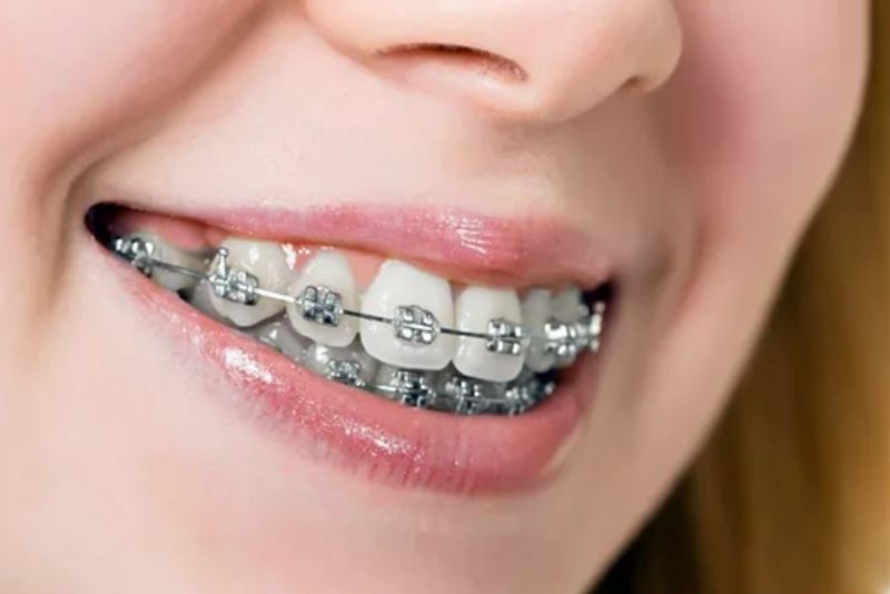Niềng răng mắc cài kim loại phù hợp cho người đã bọc sứ