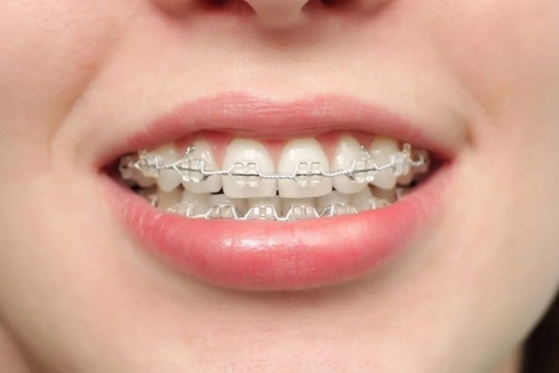 Răng đã bọc sứ