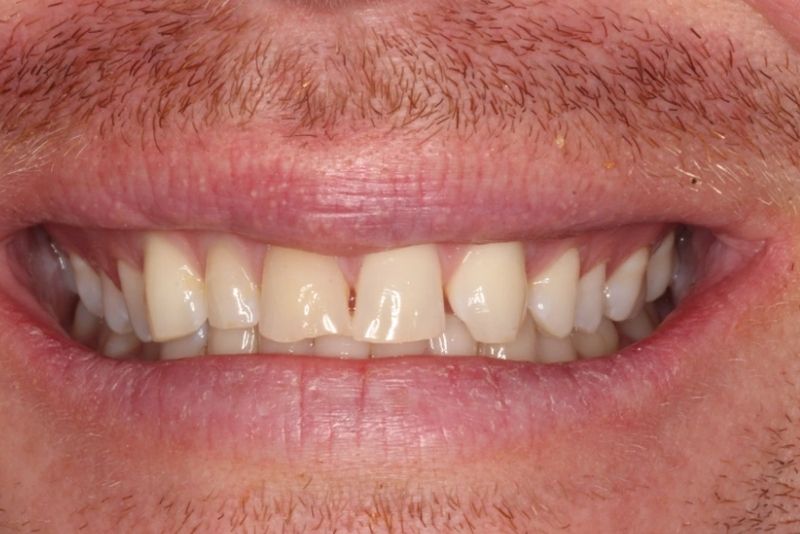 Răng mẻ nhẹ có thể dán sứ