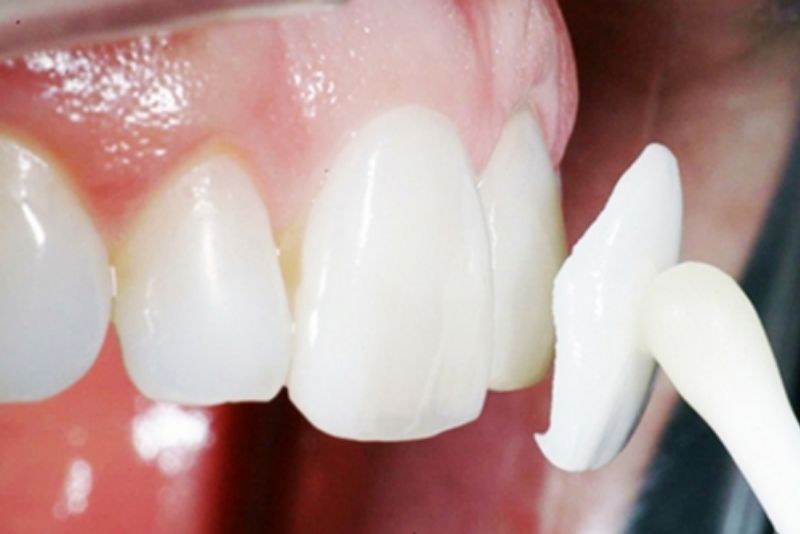 Răng lệch nhẹ có thể dán sứ Veneer