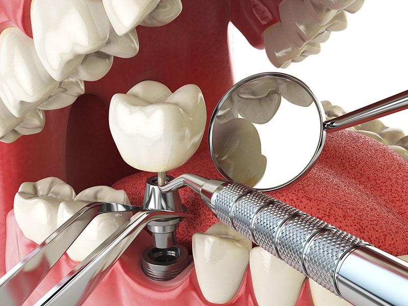 Trồng Implant là giải pháp hiệu quả hiện nay