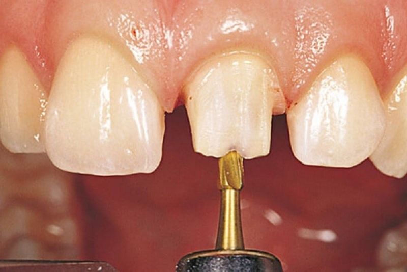 Bọc mão sứ sai kỹ thuật cũng khiến răng ố vàng