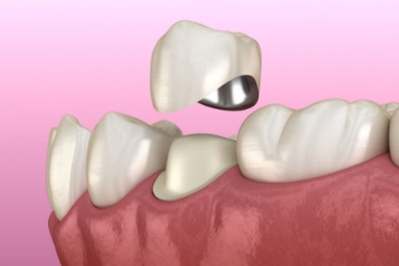 Thay mão sứ mới