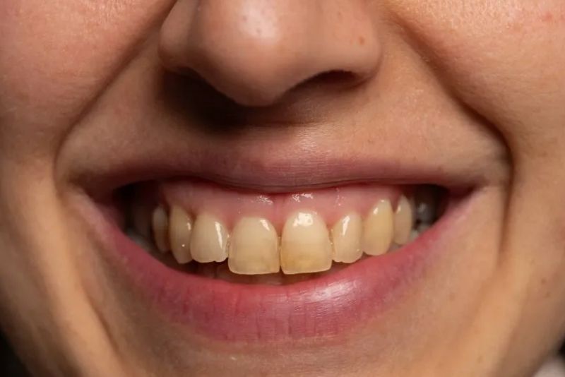Vệ sinh sai cách khiến răng sứ ố vàng