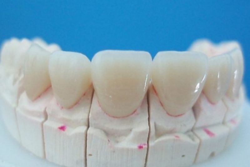 Răng sứ Ceramill tương thích cao